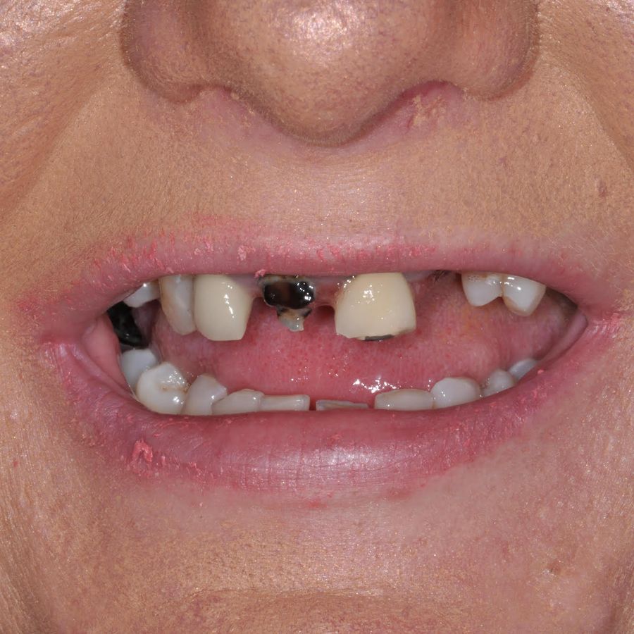 Paula cronnelly - smile in a day - before - 3Dental